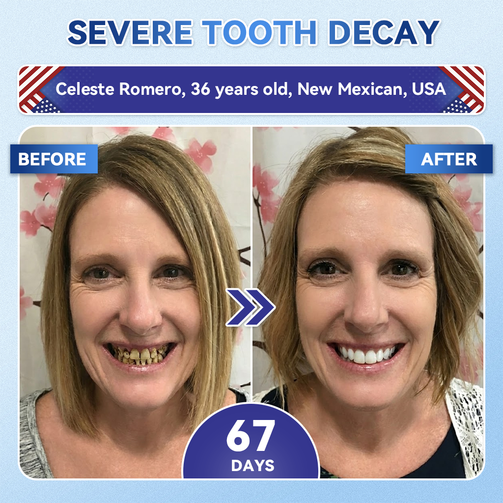 |🇺🇸 𝐎𝐟𝐟𝐢𝐜𝐢𝐚𝐥 𝐔𝐒 𝐒𝐭𝐨𝐫𝐞 | 𝐙𝐔𝐄𝐄𝐓® 🦷 Tideglusib Fast‑Dissolving Tooth & Gum Repair Oral Strips ✨ (Supports tooth repair and helps relieve gum discomfort and other common oral concerns)